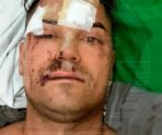 turist na bali2 e1724113117249 Российский турист заплатил уже почти миллион рублей за лечение после падения с горы в деревне мертвых на острове Бали