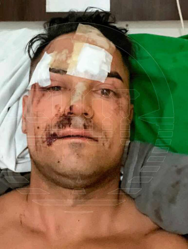 turist na bali2 e1724113117249 Российский турист заплатил уже почти миллион рублей за лечение после падения с горы в деревне мертвых на острове Бали