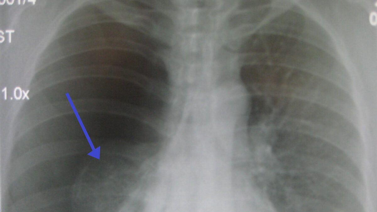 Фото: wikimedia/James Heilman, MD/CC BY 3.0