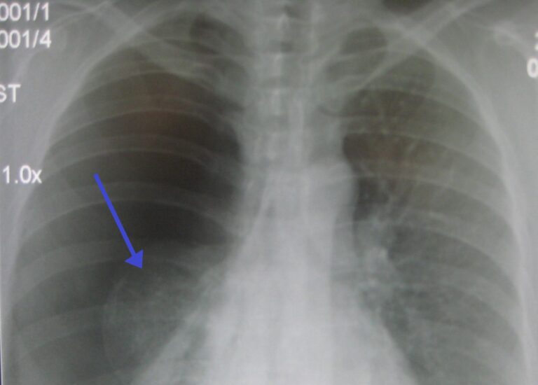 Фото: wikimedia/James Heilman, MD/CC BY 3.0